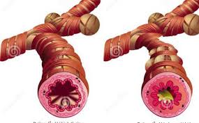 Hen phế quản - Hình ảnh minh họa